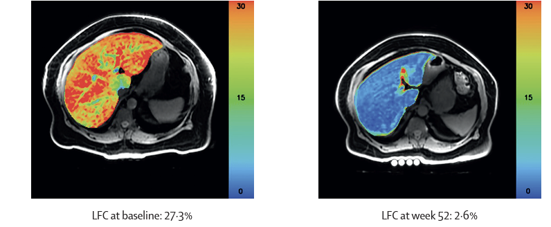 MRI