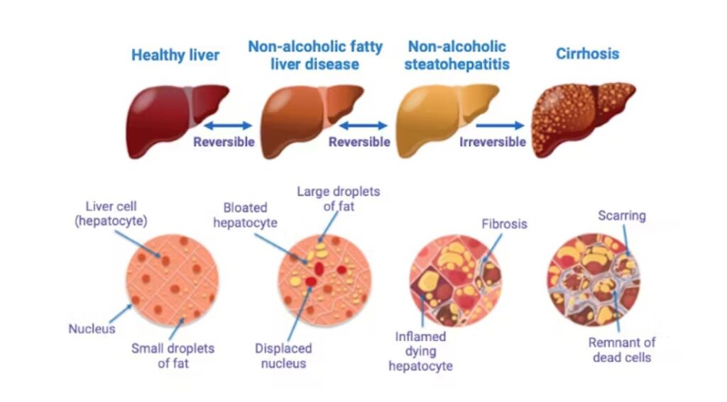 fatty liver disease