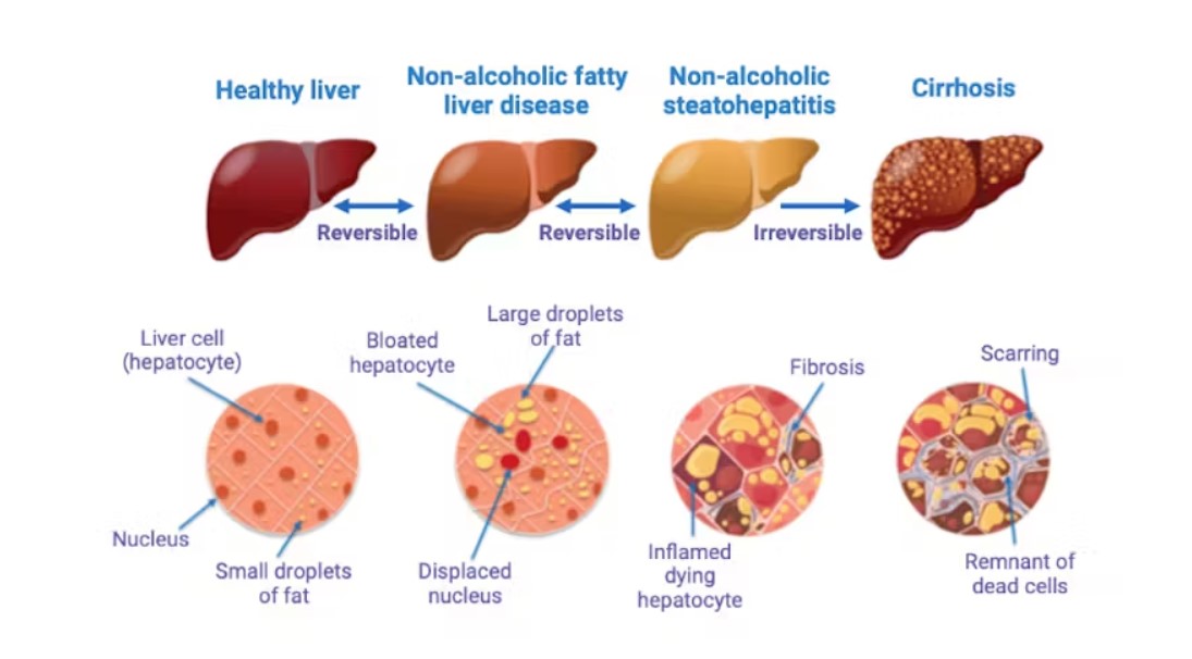 Mounjaro can CURE Fatty Liver